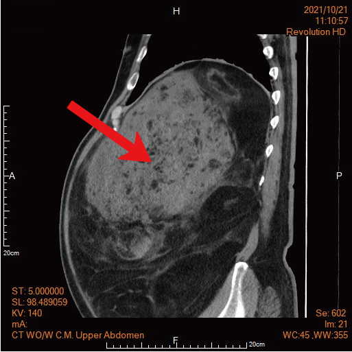 大肚腩不是脂肪堆積竟是巨大腫瘤？說明圖片