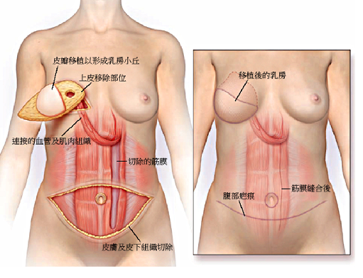 乳房重建示意圖