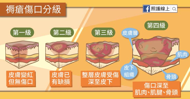 褥瘡傷口分級