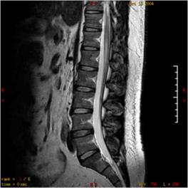 腰椎矢狀面影像