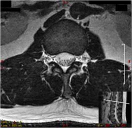 腰椎軸面影像